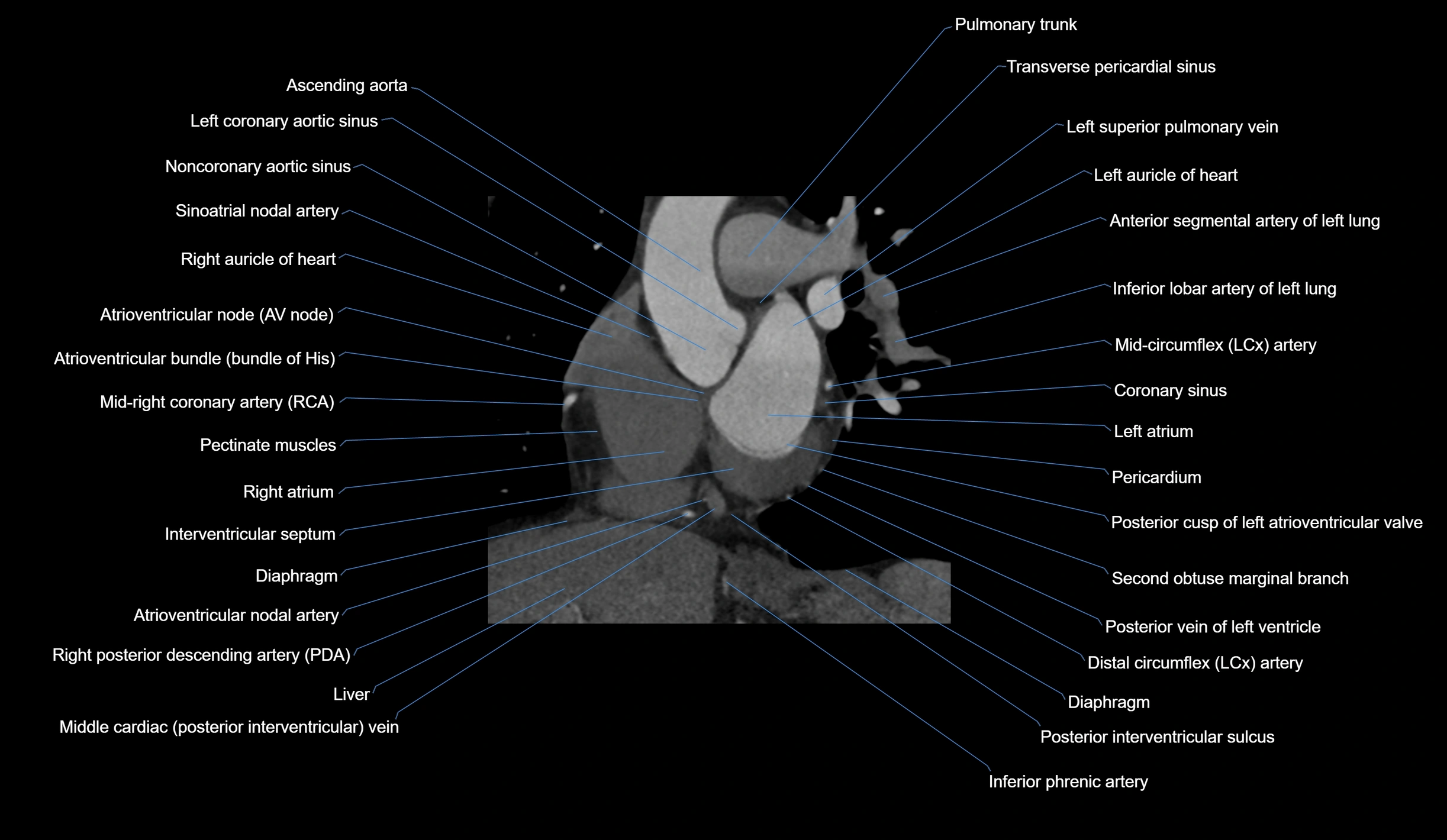 CT heart (coronary angiogram) short axis view  cross sectional anatomy labelled radiology image-00019.webp